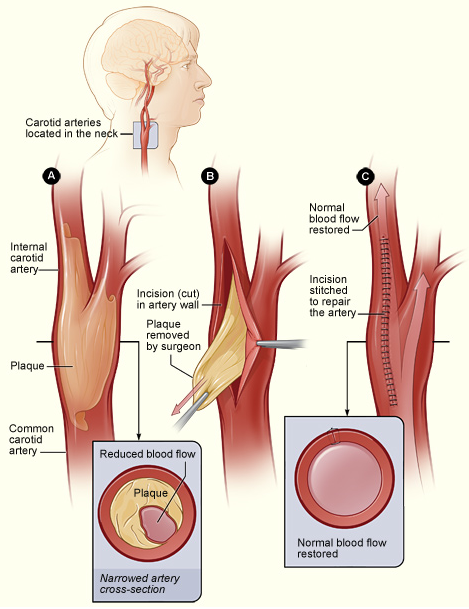 Carotid graphic1