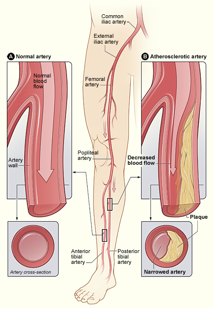 femoral artery pain