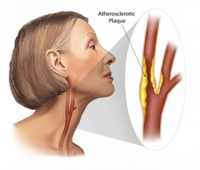 carotid plaque