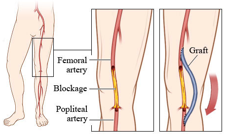 femoral bypass graphic