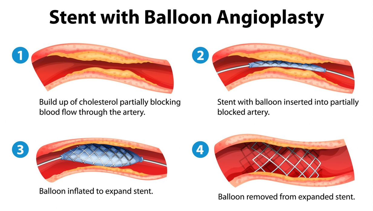 stent_angioplasty