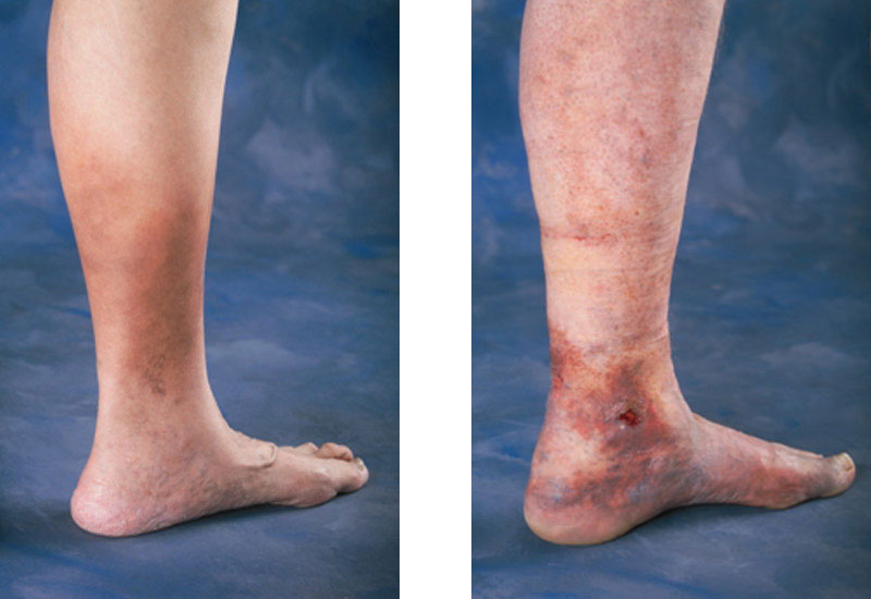 quick-and-painless-varicose-vein-treatment-options